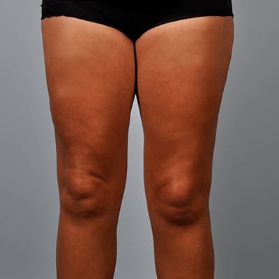 Liposuction Before & After Gallery - Patient 154948660 - Image 2