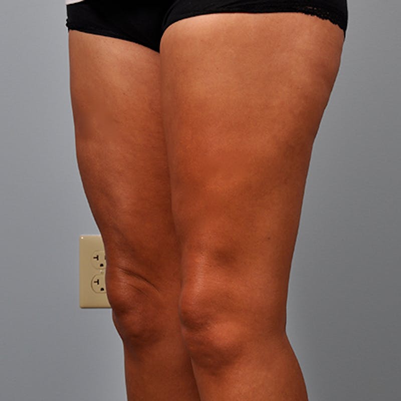 Liposuction Before & After Gallery - Patient 154948660 - Image 4