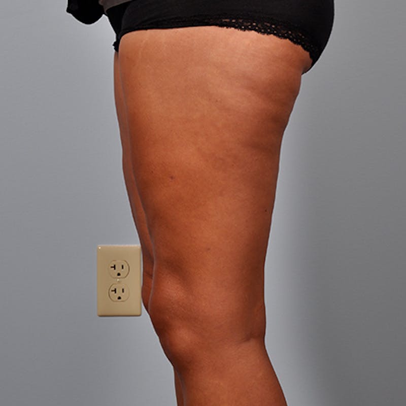 Liposuction Before & After Gallery - Patient 154948660 - Image 6