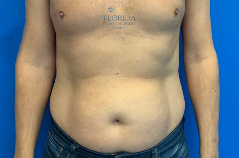 Liposuction Before & After Gallery - Patient 154948661 - Image 1