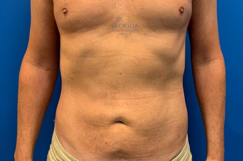 Liposuction Before & After Gallery - Patient 154948661 - Image 2
