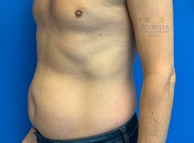 Liposuction Before & After Gallery - Patient 154948661 - Image 3
