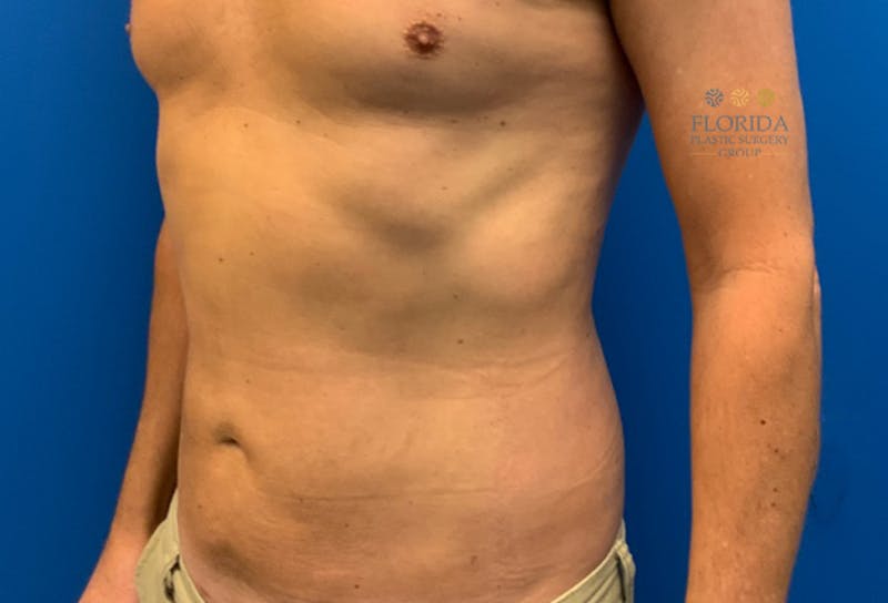 Liposuction Before & After Gallery - Patient 154948661 - Image 4