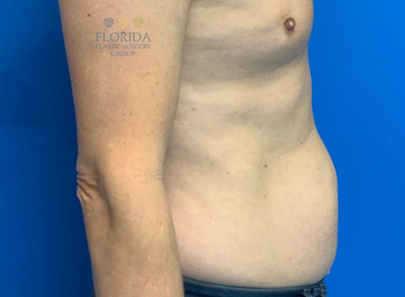 Liposuction Before & After Gallery - Patient 154948661 - Image 5