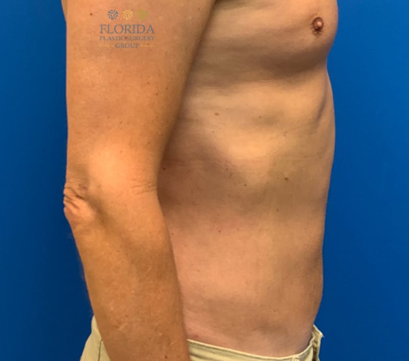 Liposuction Before & After Gallery - Patient 154948661 - Image 6