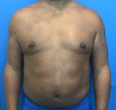 Liposuction Before & After Gallery - Patient 154948663 - Image 2