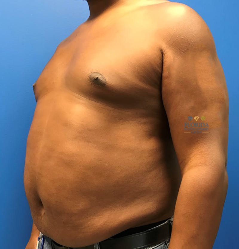 Liposuction Before & After Gallery - Patient 154948663 - Image 3