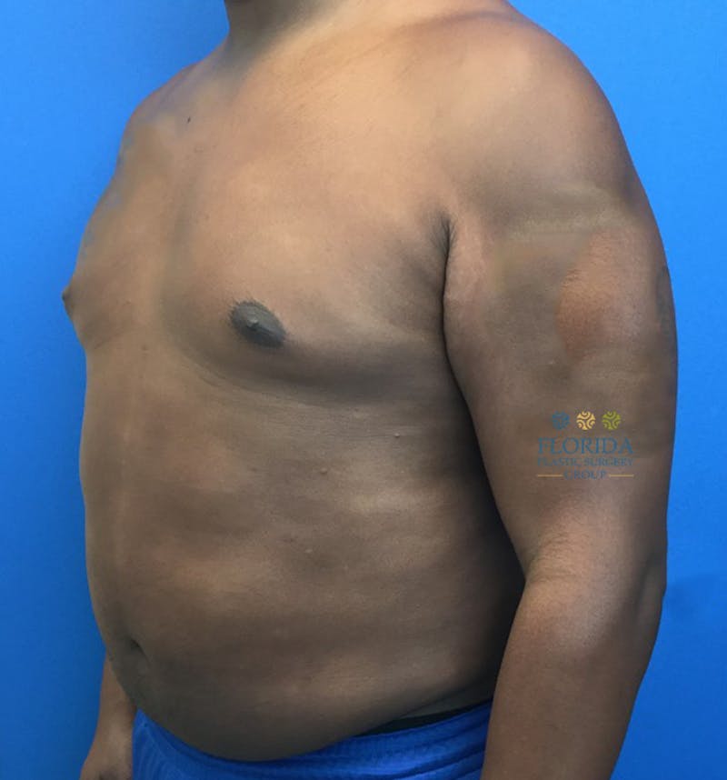 Liposuction Before & After Gallery - Patient 154948663 - Image 4
