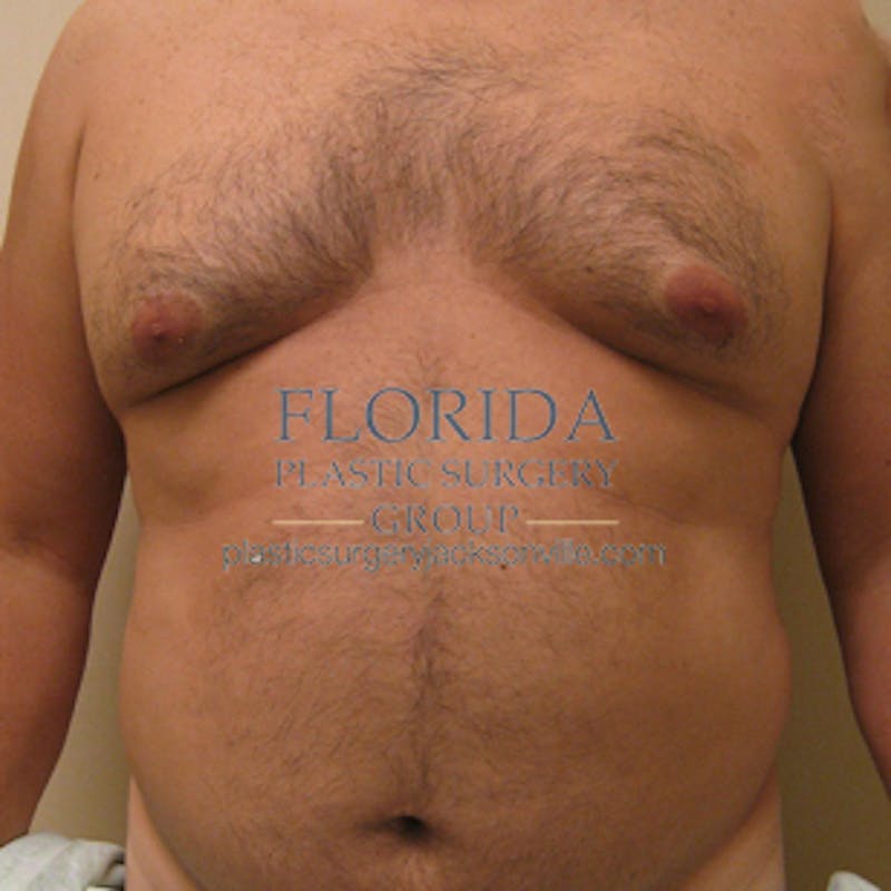 Liposuction Before & After Gallery - Patient 154948664 - Image 1