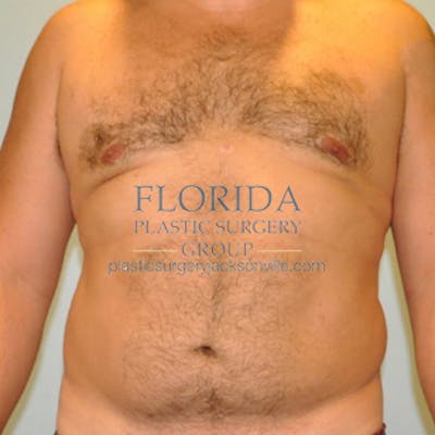 Liposuction Before & After Gallery - Patient 154948664 - Image 2