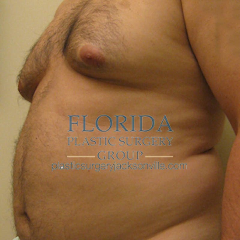 Liposuction Before & After Gallery - Patient 154948664 - Image 3