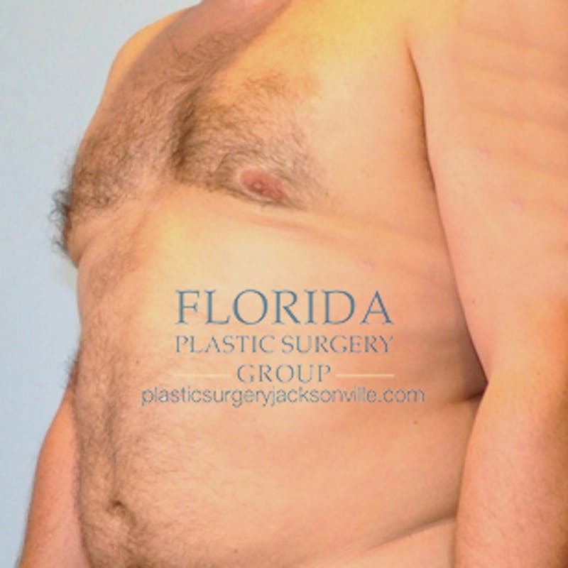 Liposuction Before & After Gallery - Patient 154948664 - Image 4