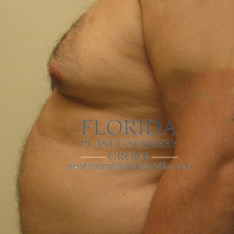 Liposuction Before & After Gallery - Patient 154948664 - Image 5