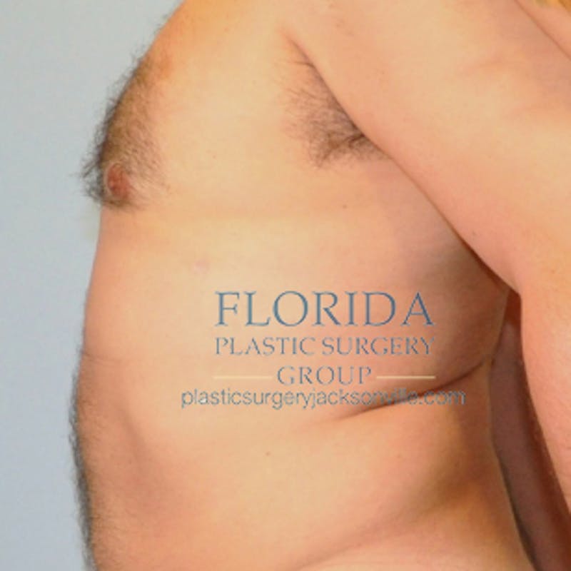 Liposuction Before & After Gallery - Patient 154948664 - Image 6