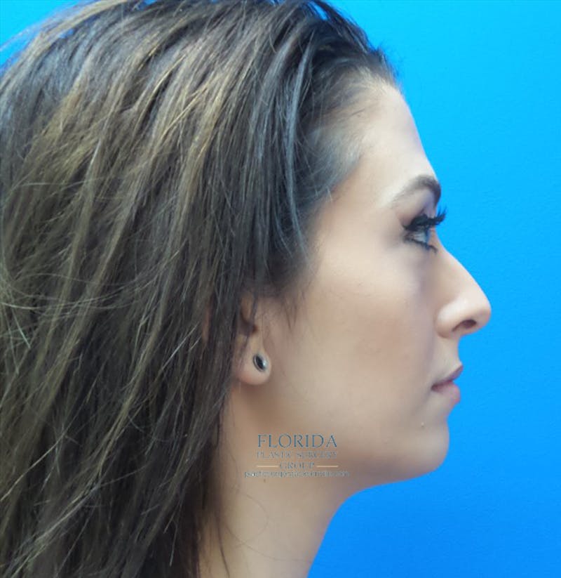 Rhinoplasty Before & After Gallery - Patient 154948669 - Image 1