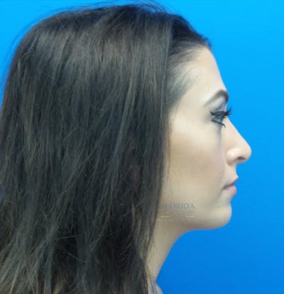 Rhinoplasty Before & After Gallery - Patient 154948669 - Image 2