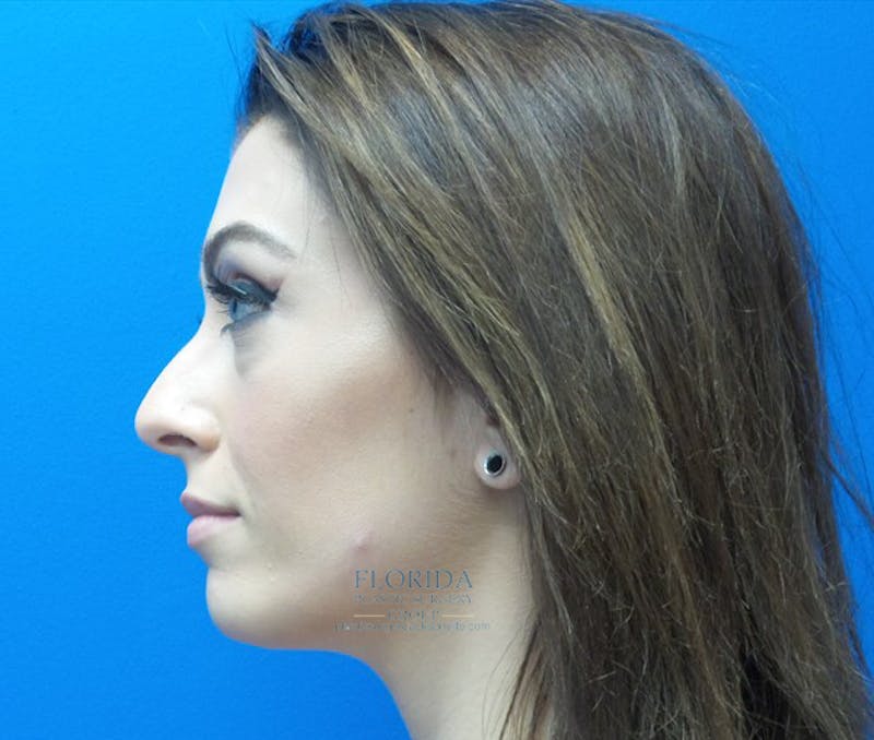 Rhinoplasty Before & After Gallery - Patient 154948669 - Image 3