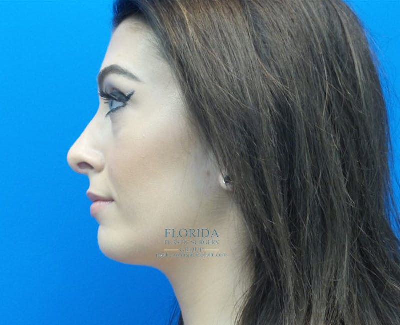 Rhinoplasty Before & After Gallery - Patient 154948669 - Image 4
