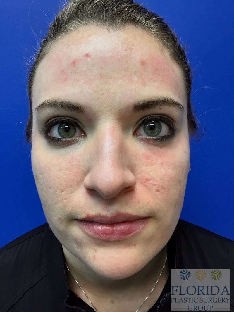 Microneedling Before & After Gallery - Patient 154948670 - Image 1