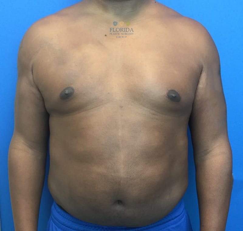 Breast & Abdominal Liposuction Before & After Gallery - Patient 154948672 - Image 2