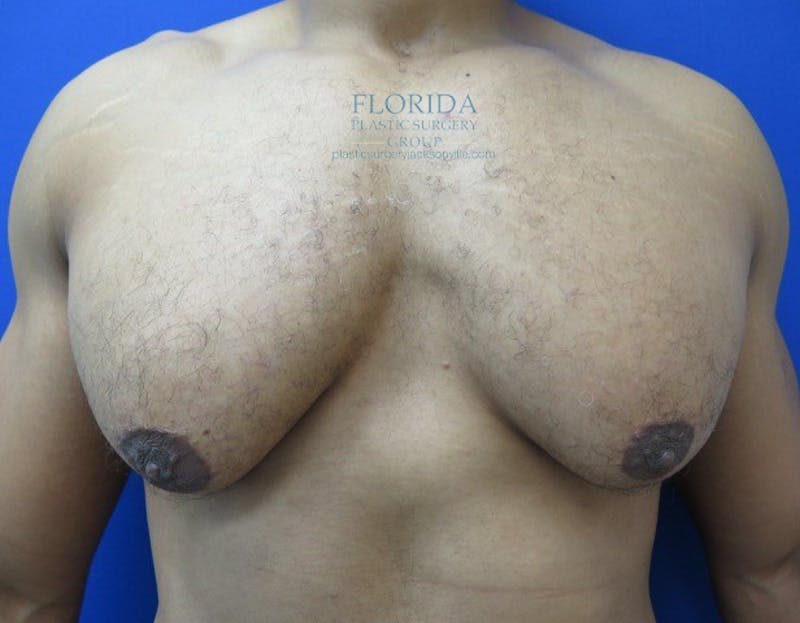 Male Breast Reduction Before & After Gallery - Patient 154948673 - Image 1