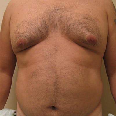 Breast & Abdominal Liposuction Before & After Gallery - Patient 154948674 - Image 1