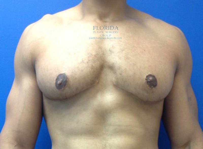 Male Breast Reduction Before & After Gallery - Patient 154948673 - Image 2