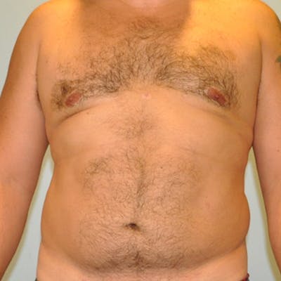 Breast & Abdominal Liposuction Before & After Gallery - Patient 154948674 - Image 2