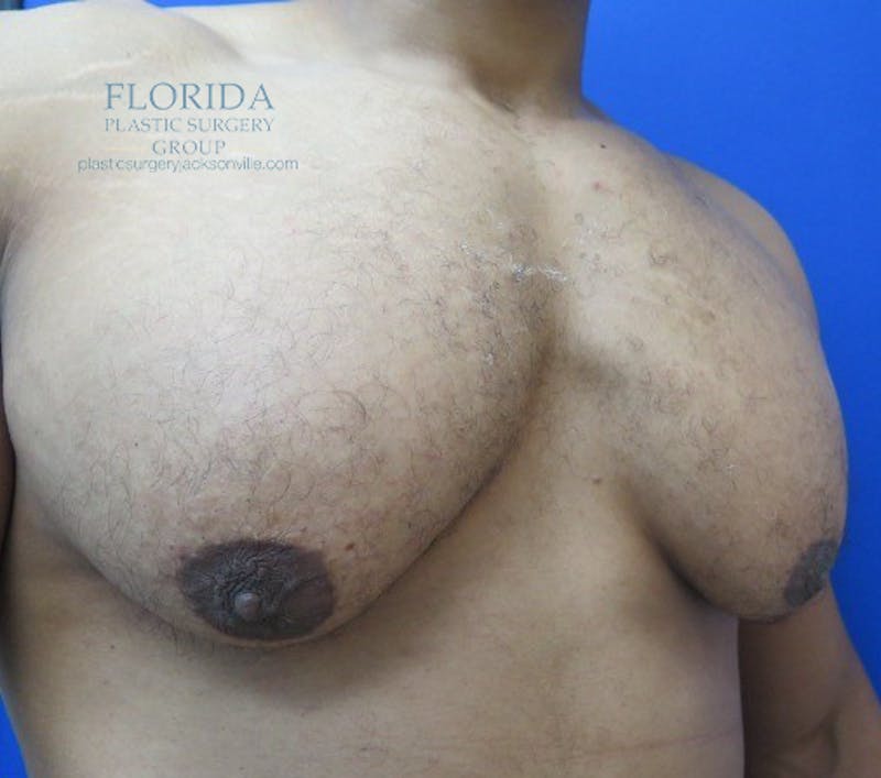 Male Breast Reduction Before & After Gallery - Patient 154948673 - Image 3
