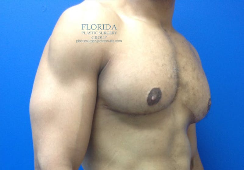Male Breast Reduction Before & After Gallery - Patient 154948673 - Image 4