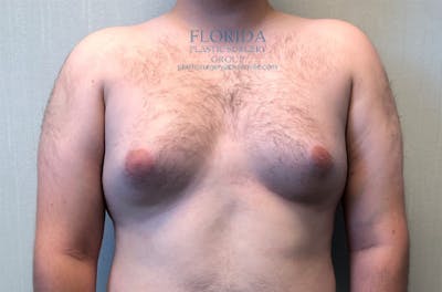 Male Breast Reduction Before & After Gallery - Patient 154948676 - Image 1