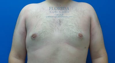 Male Breast Reduction Before & After Gallery - Patient 154948676 - Image 2