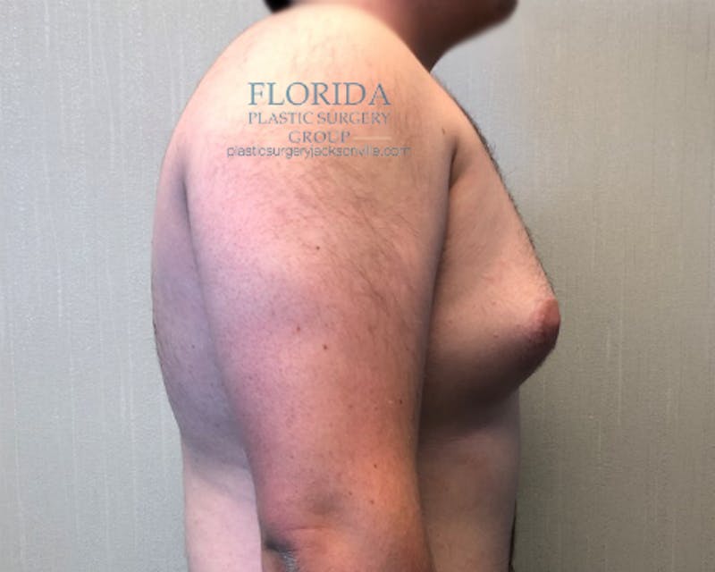 Male Breast Reduction Before & After Gallery - Patient 154948676 - Image 3