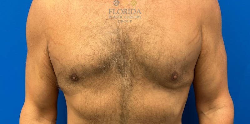 Breast & Abdominal Liposuction Before & After Gallery - Patient 154948677 - Image 2