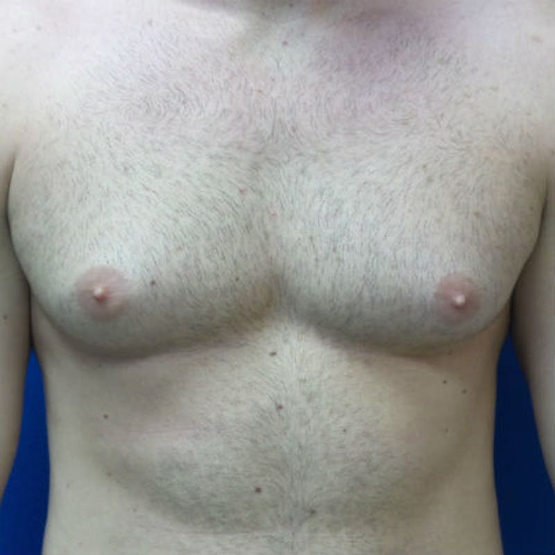 Male Breast Reduction Before & After Gallery - Patient 154948678 - Image 1