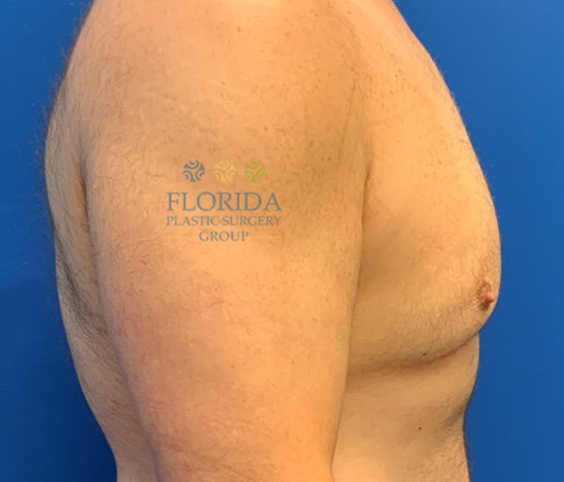 Breast & Abdominal Liposuction Before & After Gallery - Patient 154948677 - Image 3
