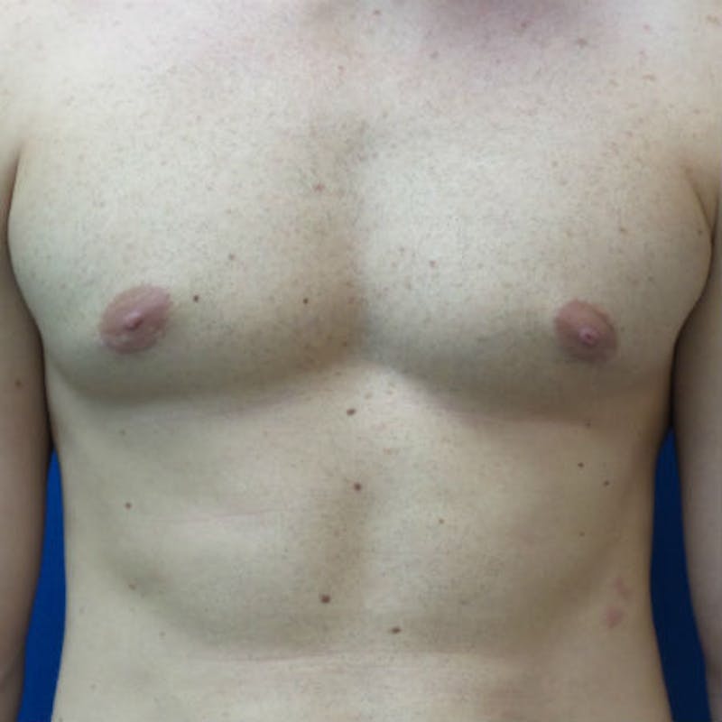 Male Breast Reduction Before & After Gallery - Patient 154948678 - Image 2
