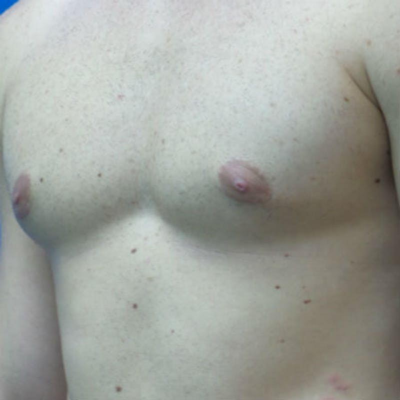 Male Breast Reduction Before & After Gallery - Patient 154948678 - Image 4