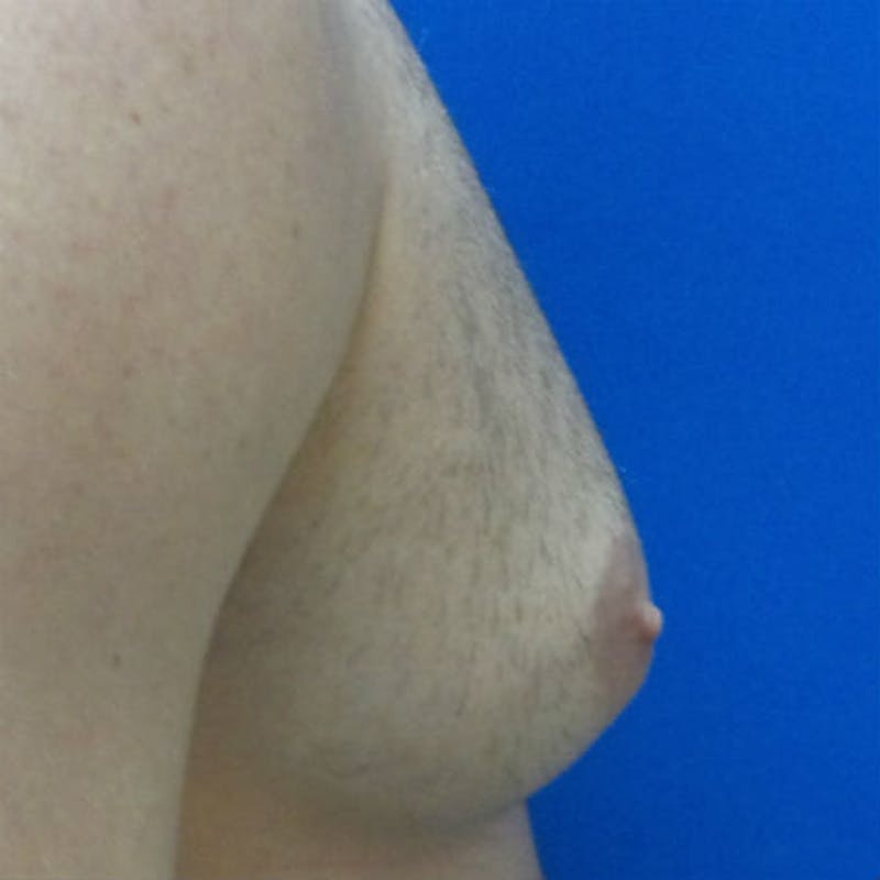 Male Breast Reduction Before & After Gallery - Patient 154948678 - Image 5