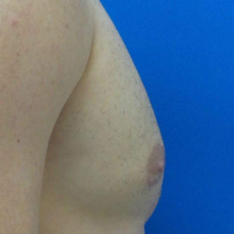 Male Breast Reduction Before & After Gallery - Patient 154948678 - Image 6