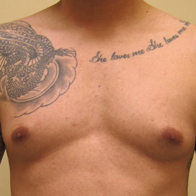 Male Breast Reduction Before & After Gallery - Patient 154948679 - Image 1