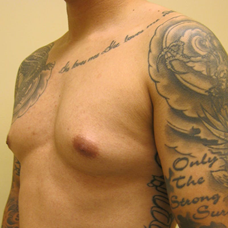 Male Breast Reduction Before & After Gallery - Patient 154948679 - Image 3