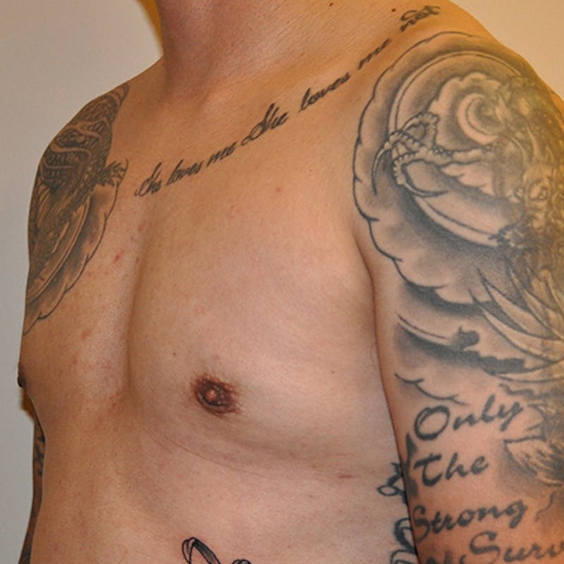 Male Breast Reduction Before & After Gallery - Patient 154948679 - Image 4