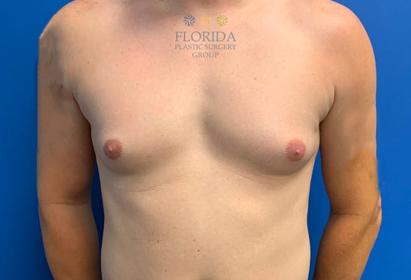 Male Breast Reduction Before & After Gallery - Patient 154948682 - Image 1