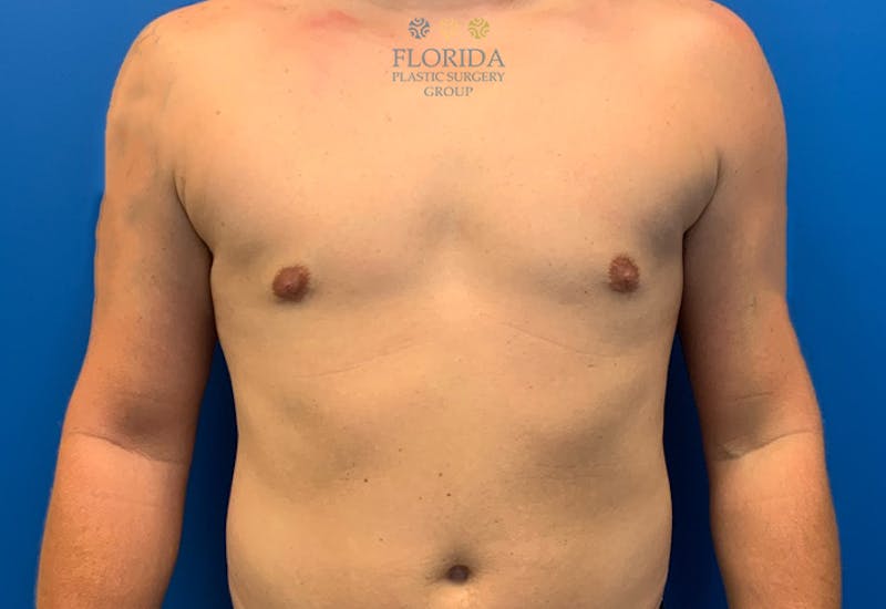 Male Breast Reduction Before & After Gallery - Patient 154948682 - Image 2