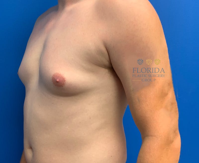 Male Breast Reduction Before & After Gallery - Patient 154948682 - Image 3