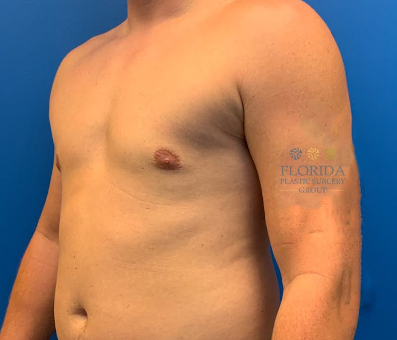 Male Breast Reduction Before & After Gallery - Patient 154948682 - Image 4