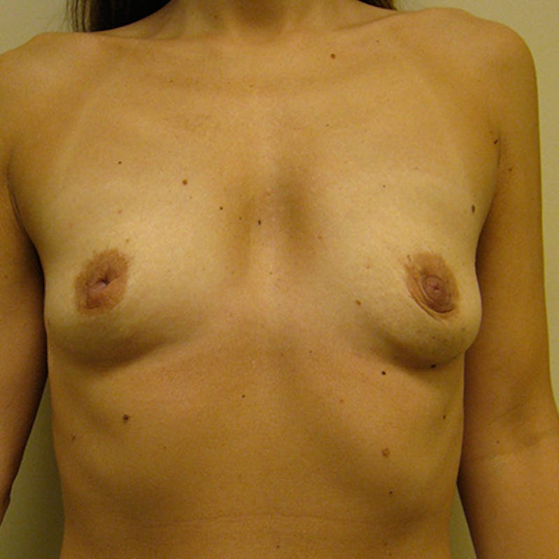 Saline Breast Augmentation Before & After Gallery - Patient 154948683 - Image 1