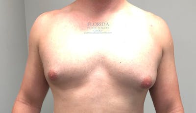 Male Breast Reduction Before & After Gallery - Patient 154948684 - Image 1