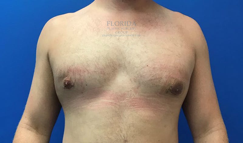 Male Breast Reduction Before & After Gallery - Patient 154948684 - Image 2